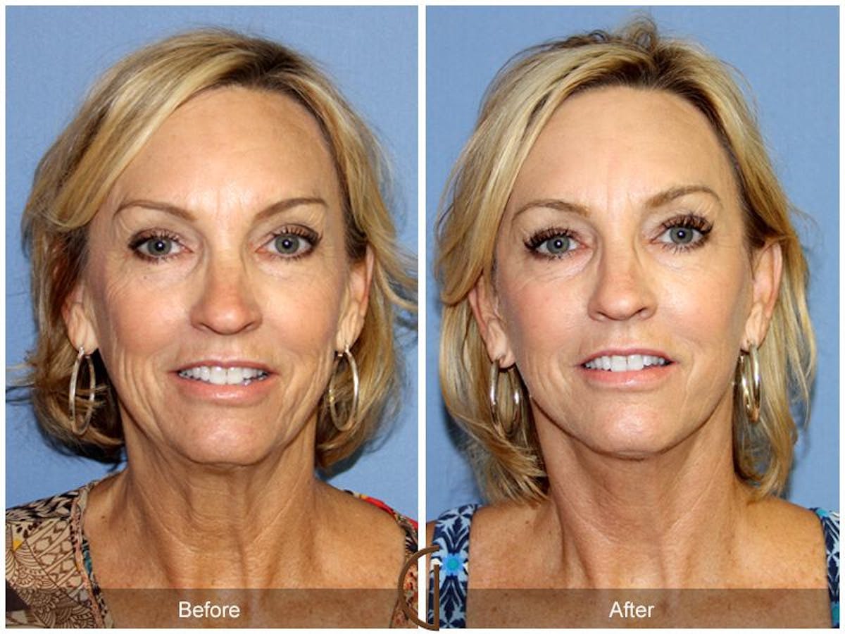 Facelift 50s Before & After Gallery - Patient 135901 - Image 2