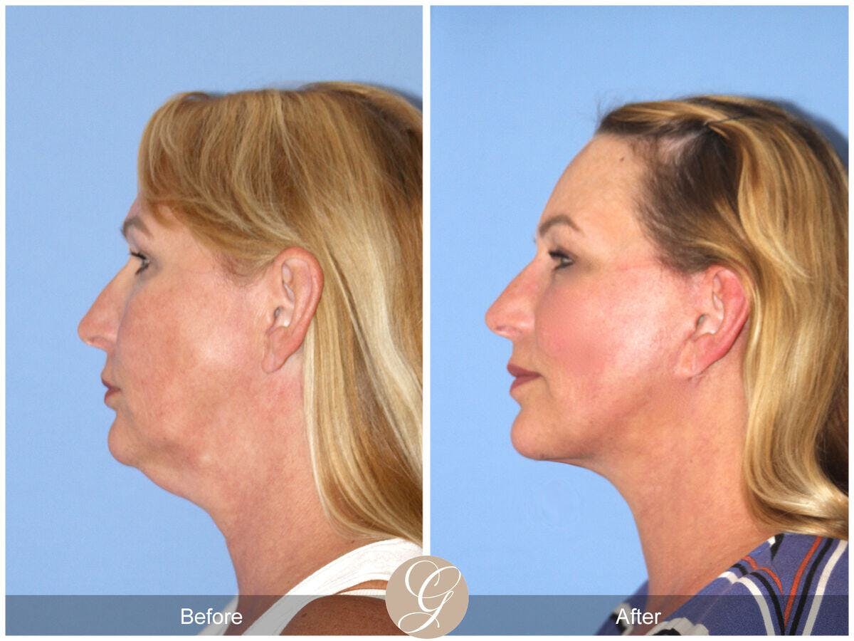 Facelift 50s Before & After Gallery - Patient 258817 - Image 1