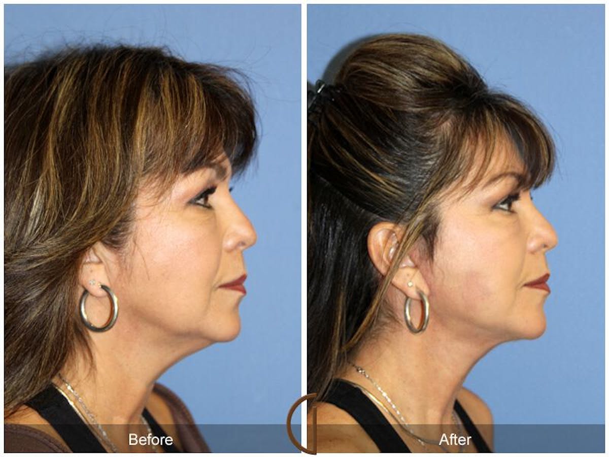Facelift 50s Before & After Gallery - Patient 170900 - Image 3