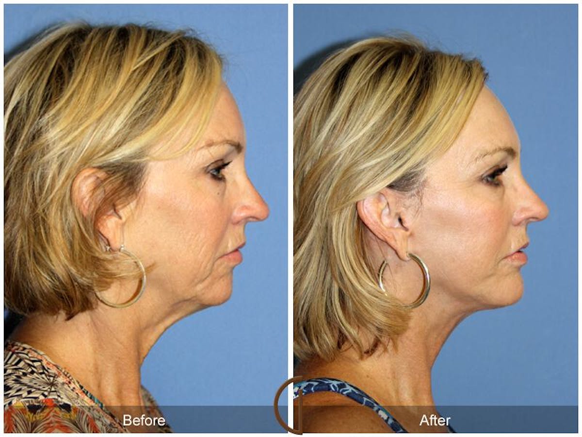 Facelift 50s Before & After Gallery - Patient 135901 - Image 3