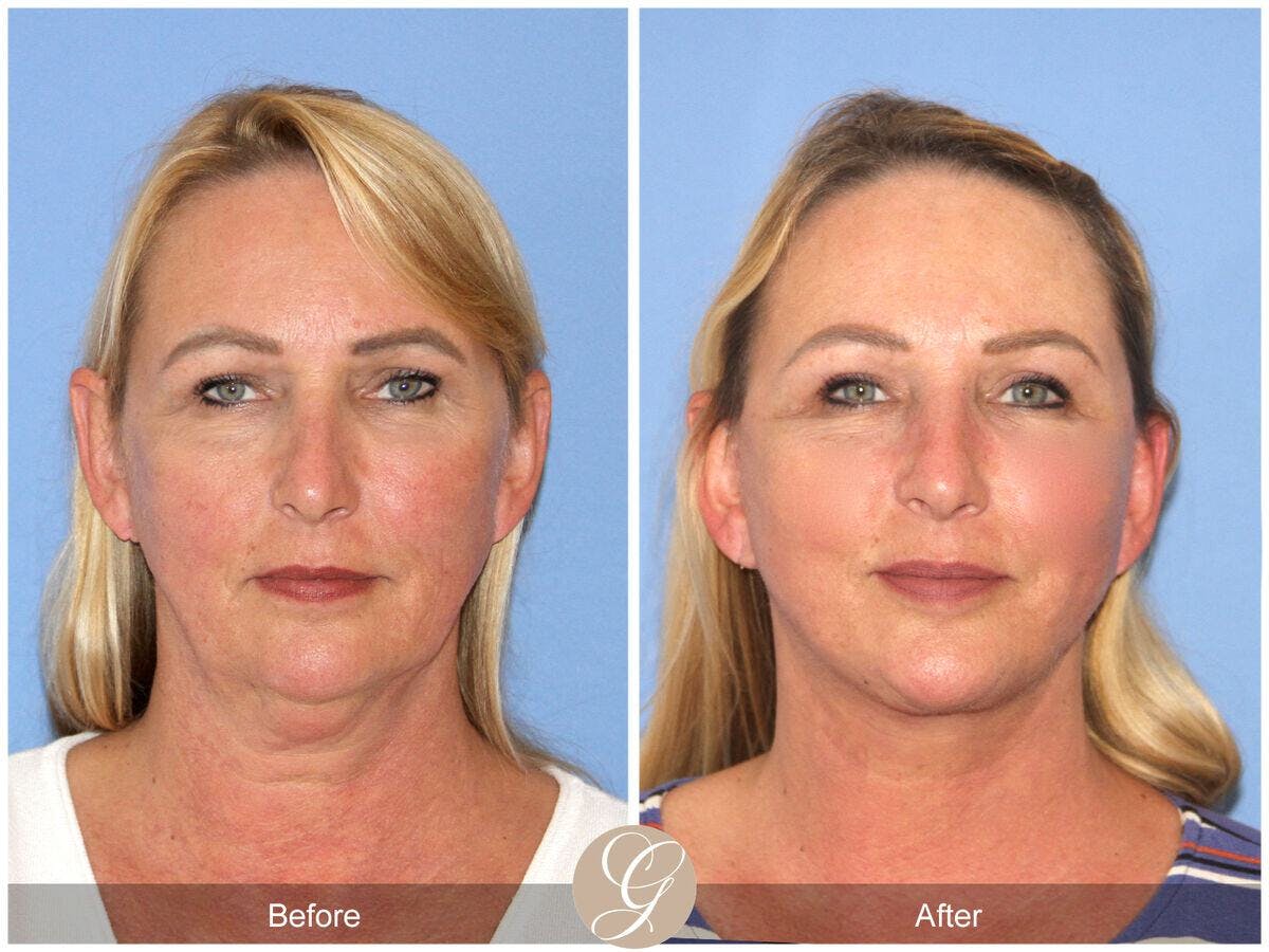 Facelift 50s Before & After Gallery - Patient 258817 - Image 2