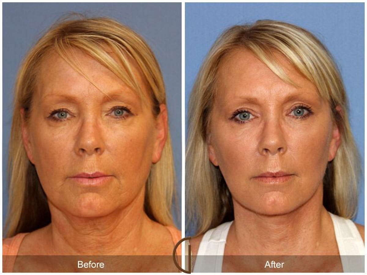 Facelift 50s Before & After Gallery - Patient 197198 - Image 2