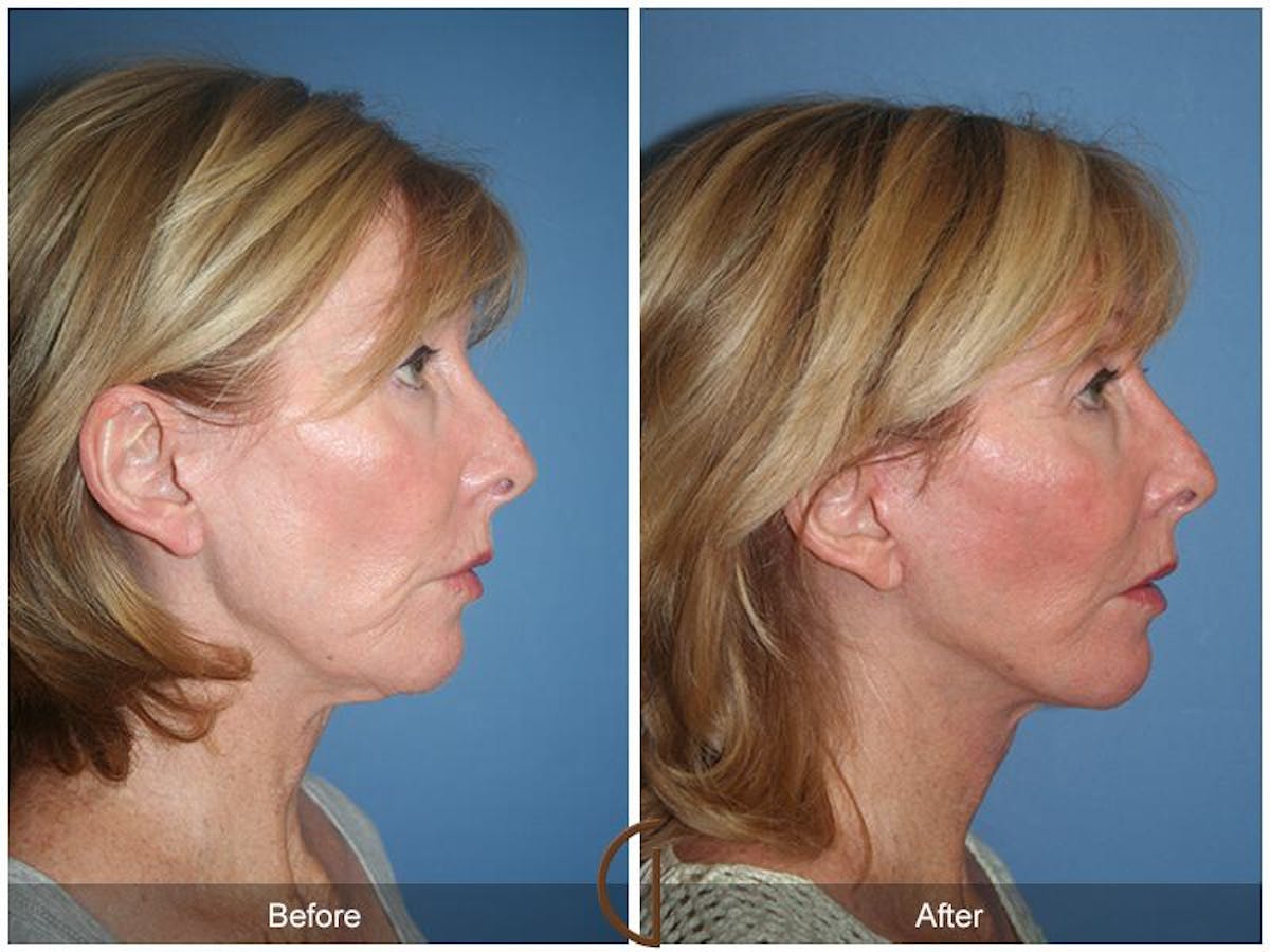 Facelift 50s Before & After Gallery - Patient 354704 - Image 3