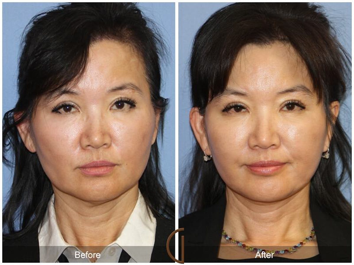 Facelift 50s Before & After Gallery - Patient 403358 - Image 2