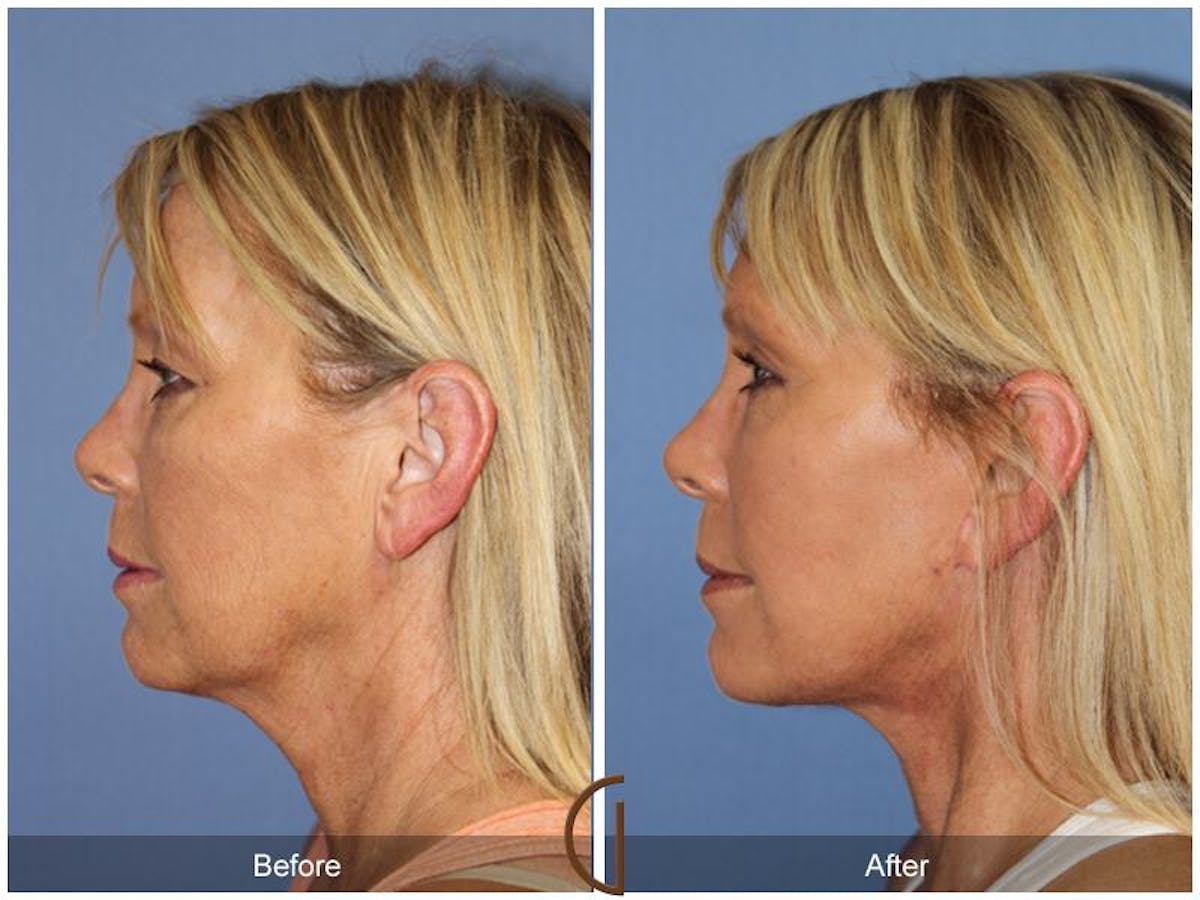 Facelift 50s Before & After Gallery - Patient 197198 - Image 1