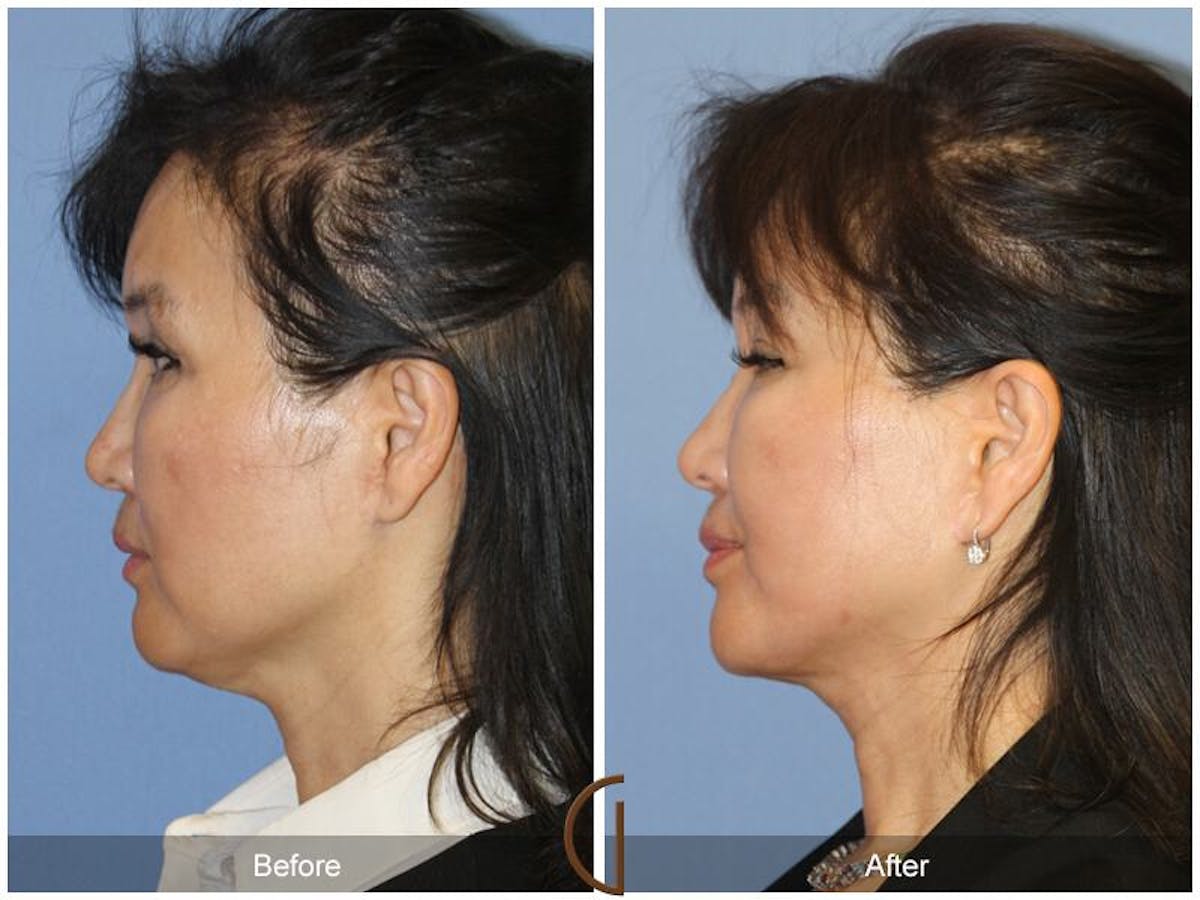Facelift 50s Before & After Gallery - Patient 403358 - Image 1