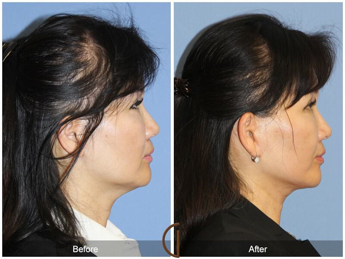 Facelift 50s Before & After Gallery - Patient 403358 - Image 3