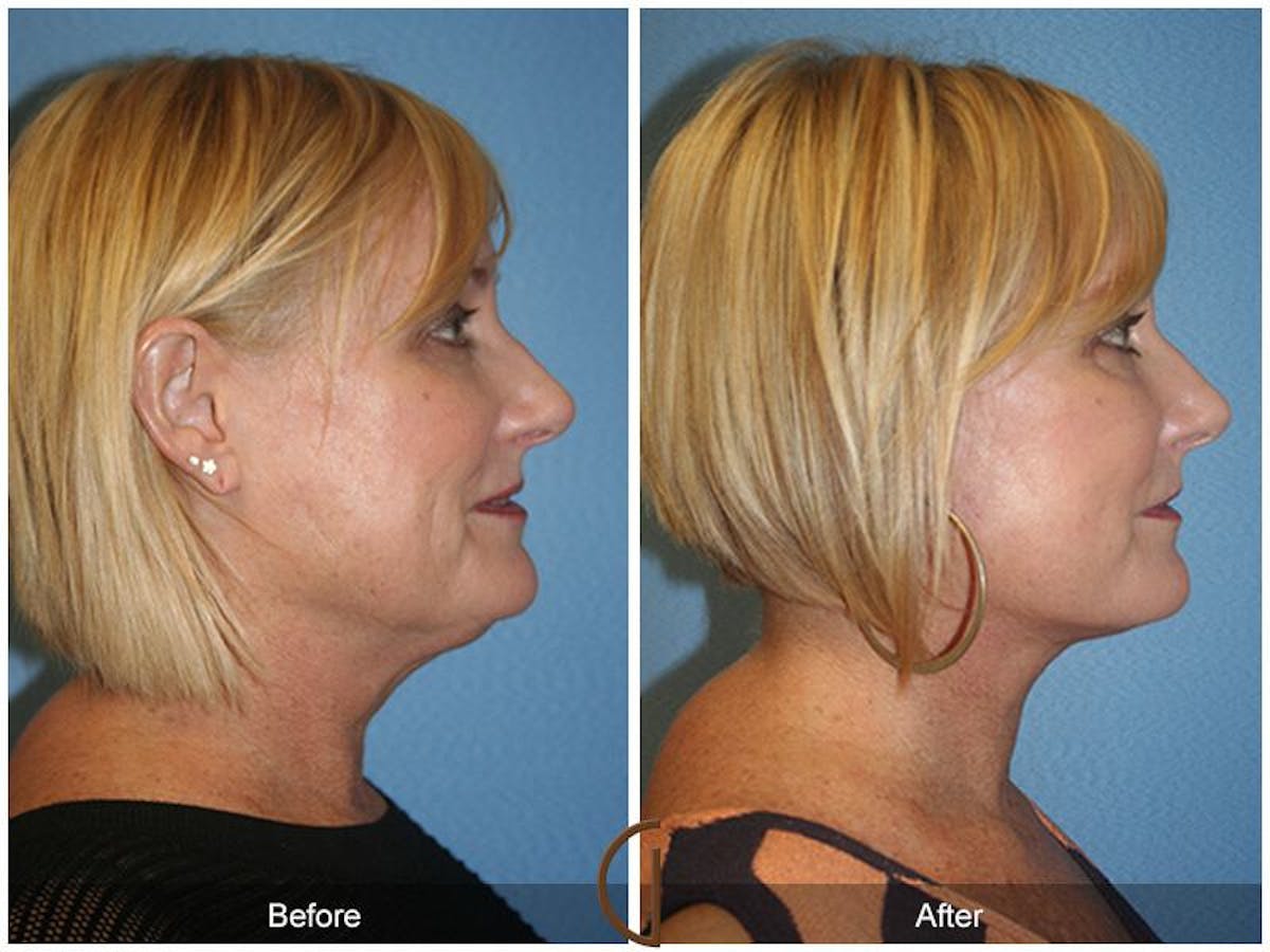 Facelift 50s Before & After Gallery - Patient 406114 - Image 3