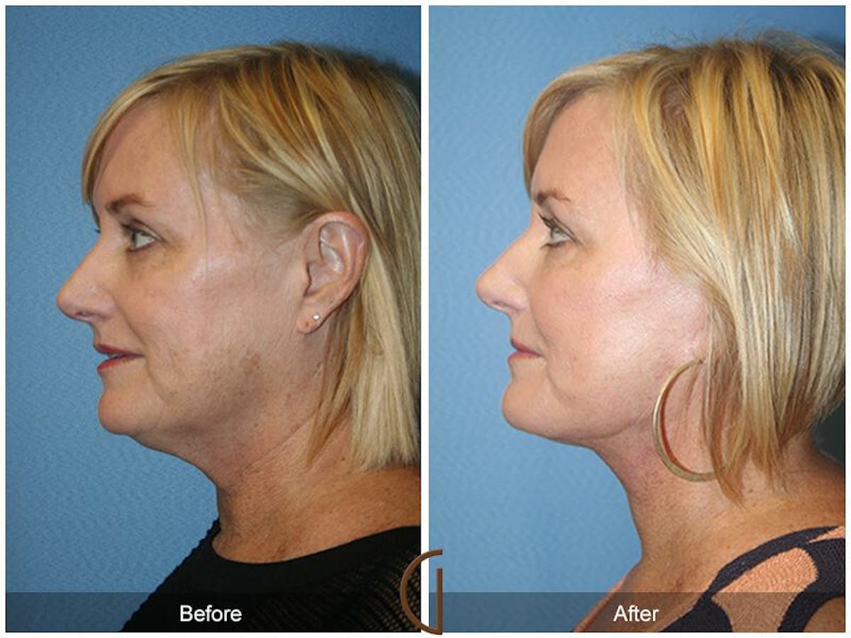 Facelift 50s Before & After Gallery - Patient 406114 - Image 1