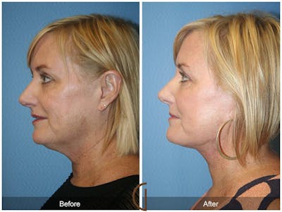 Facelift 50s Before & After Gallery - Patient 406114 - Image 1