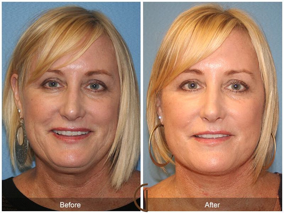 Facelift 50s Before & After Gallery - Patient 406114 - Image 2