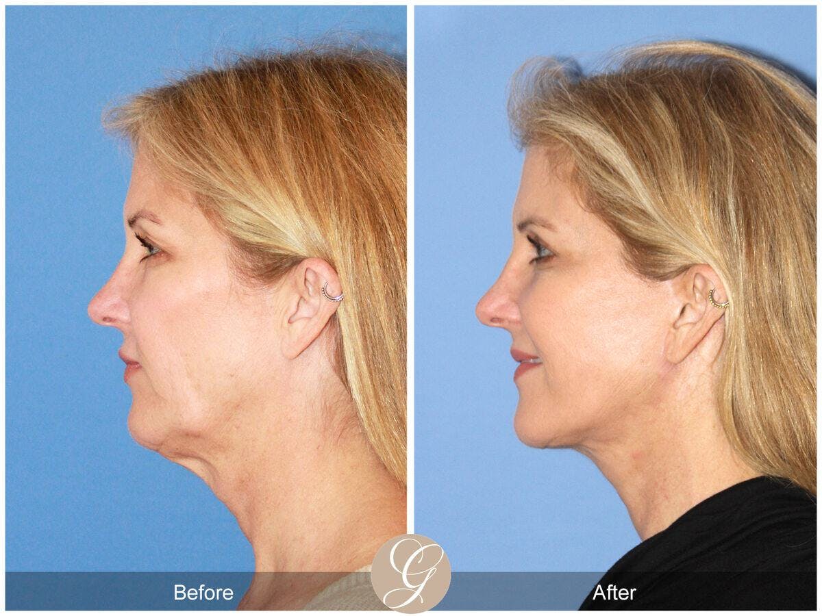 Facelift 50s Before & After Gallery - Patient 392751 - Image 1