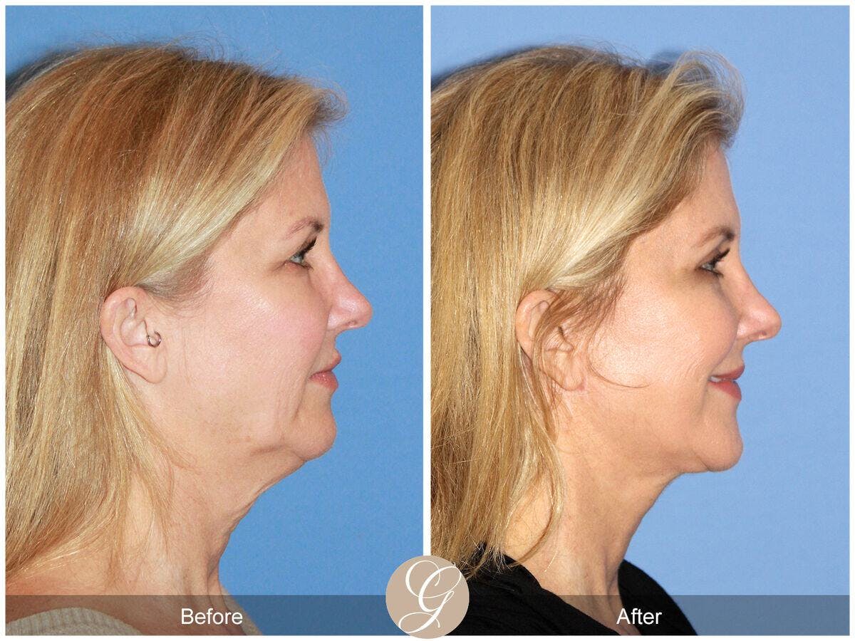Facelift 50s Before & After Gallery - Patient 392751 - Image 3