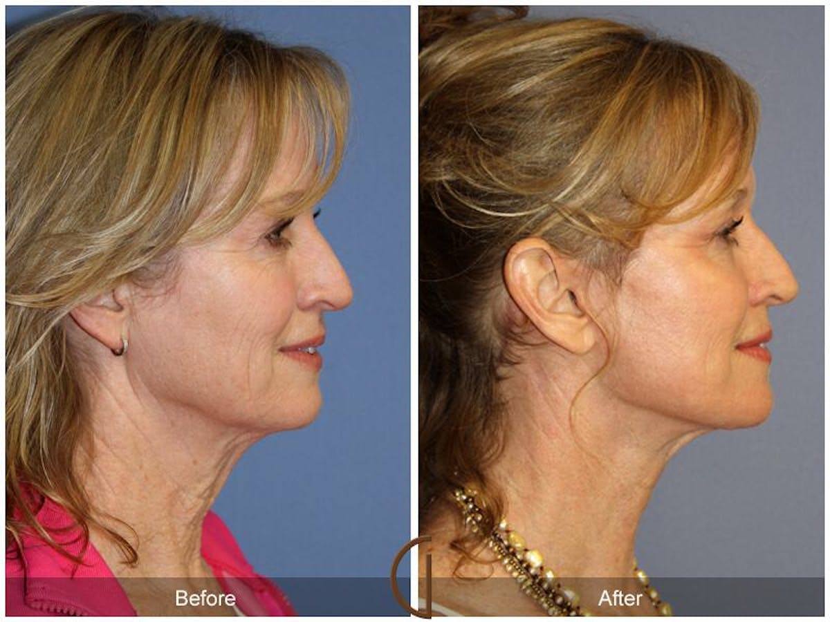 Facelift 50s Before & After Gallery - Patient 283184 - Image 3