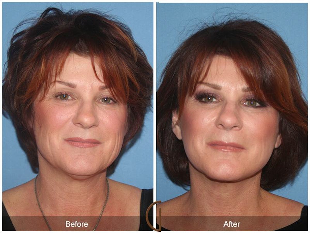 Facelift 50s Before & After Gallery - Patient 248333 - Image 2