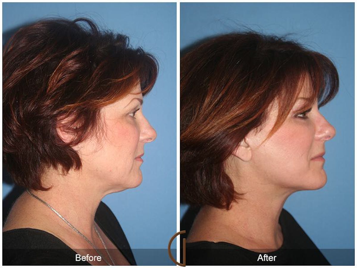 Facelift 50s Before & After Gallery - Patient 248333 - Image 3