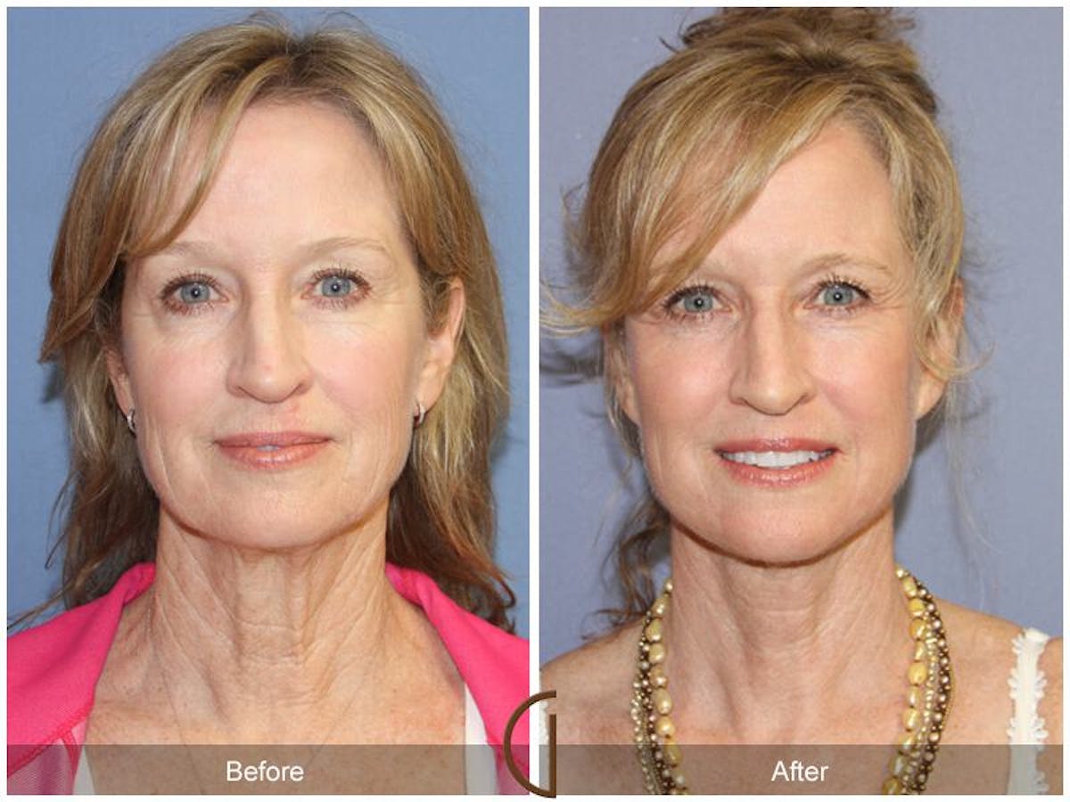 Facelift 50s Before & After Gallery - Patient 283184 - Image 2