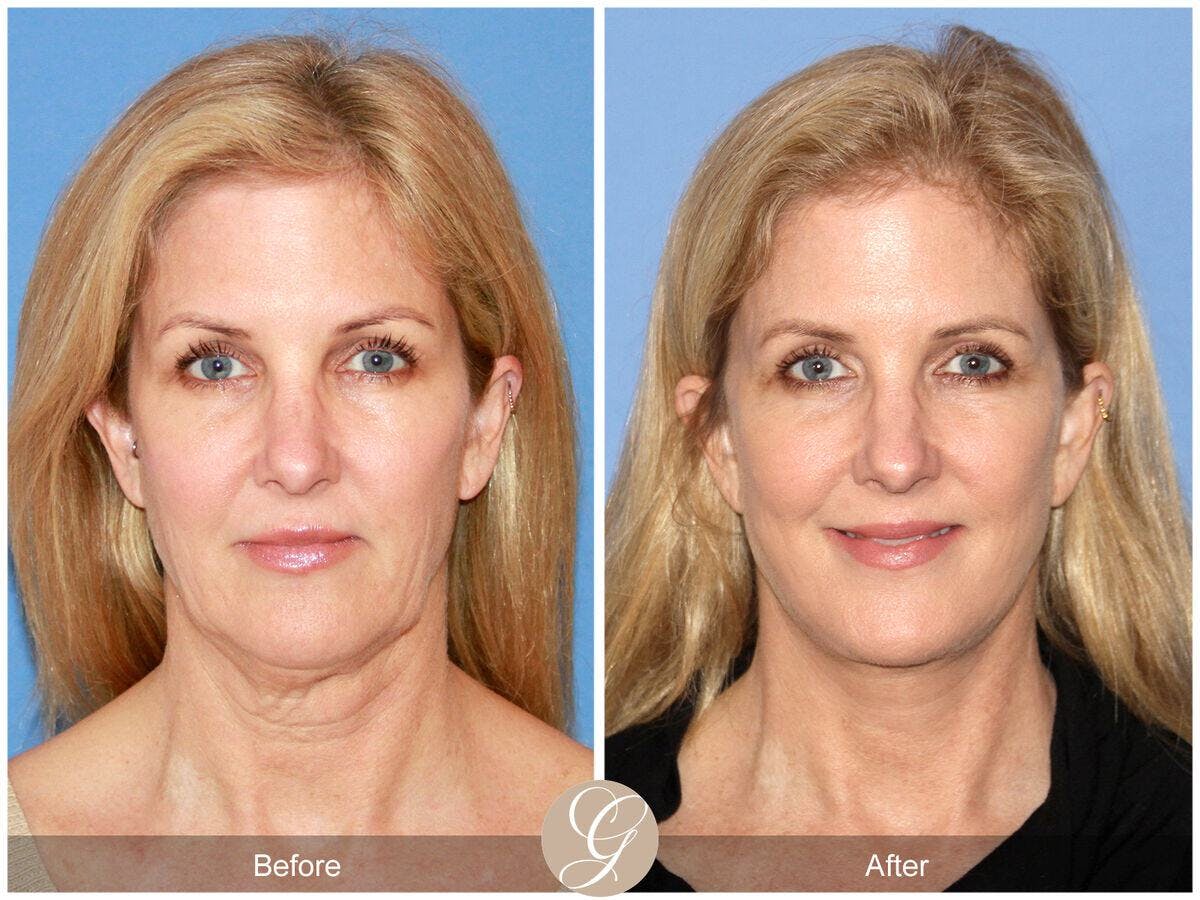 Facelift 50s Before & After Gallery - Patient 392751 - Image 2