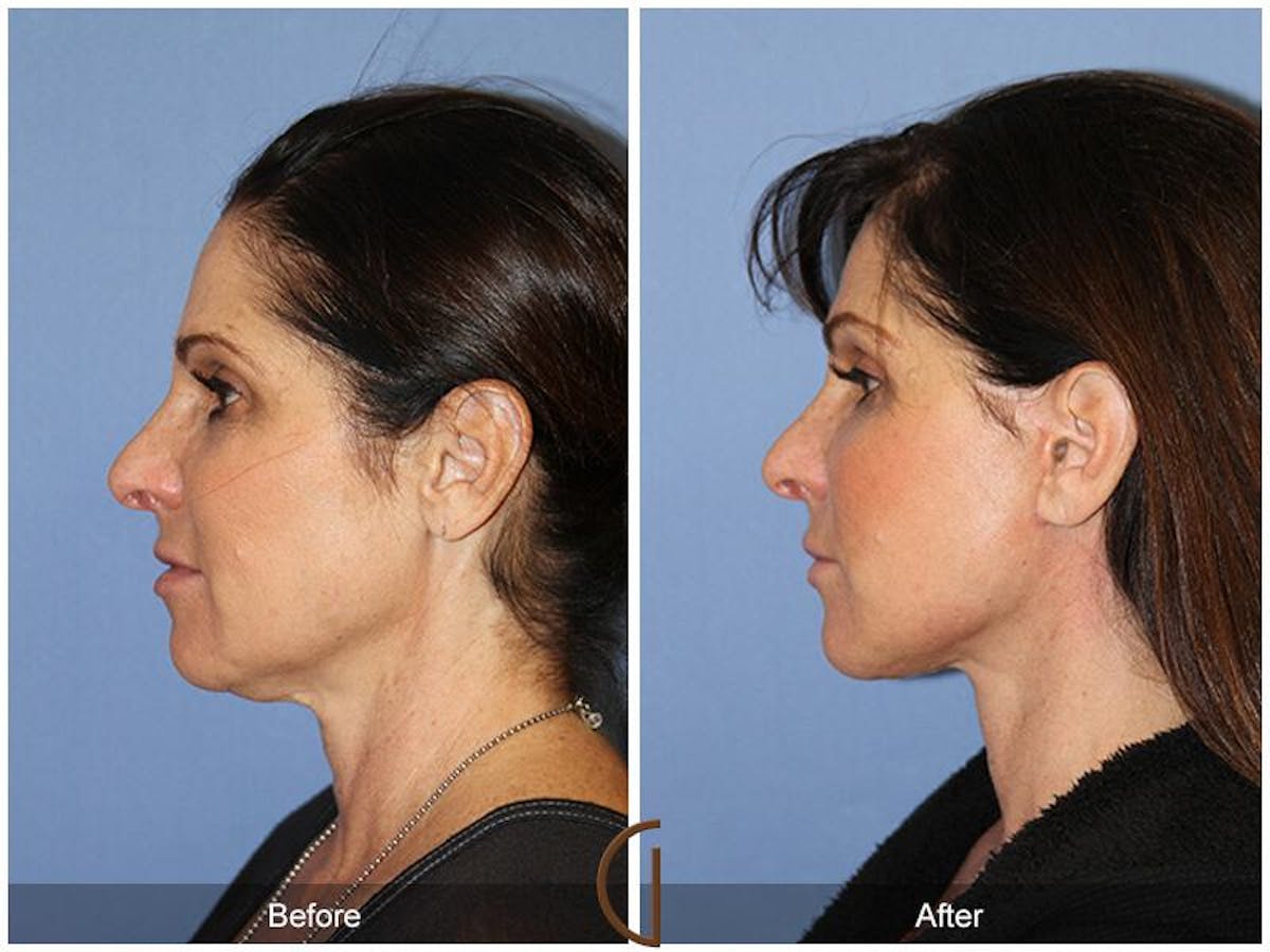 Facelift 50s Before & After Gallery - Patient 379063 - Image 1