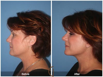 Facelift 50s Before & After Gallery - Patient 248333 - Image 1
