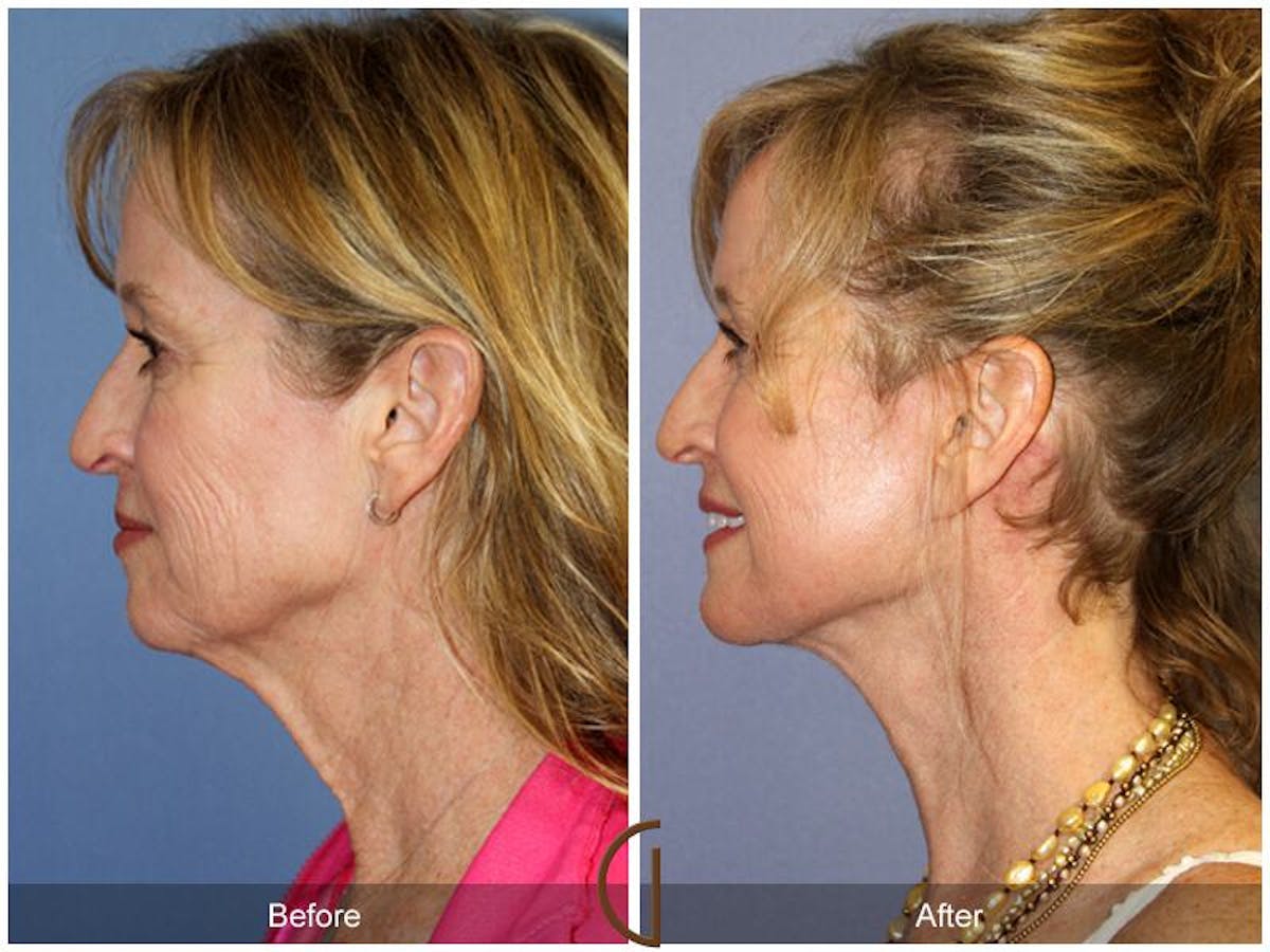 Facelift 50s Before & After Gallery - Patient 283184 - Image 1