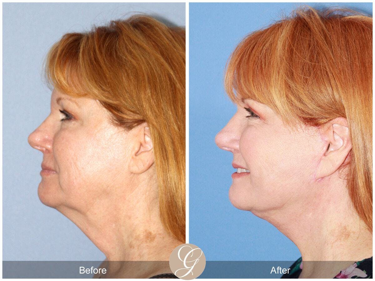 Facelift 50s Before & After Gallery - Patient 126094 - Image 1