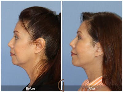 Facelift 50s Before & After Gallery - Patient 100259 - Image 1