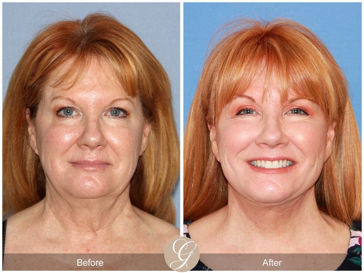 Facelift 50s Before & After Gallery - Patient 126094 - Image 2