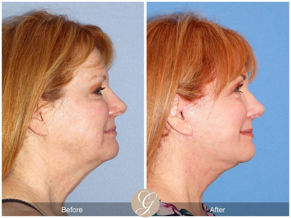 Facelift 50s Before & After Gallery - Patient 126094 - Image 3