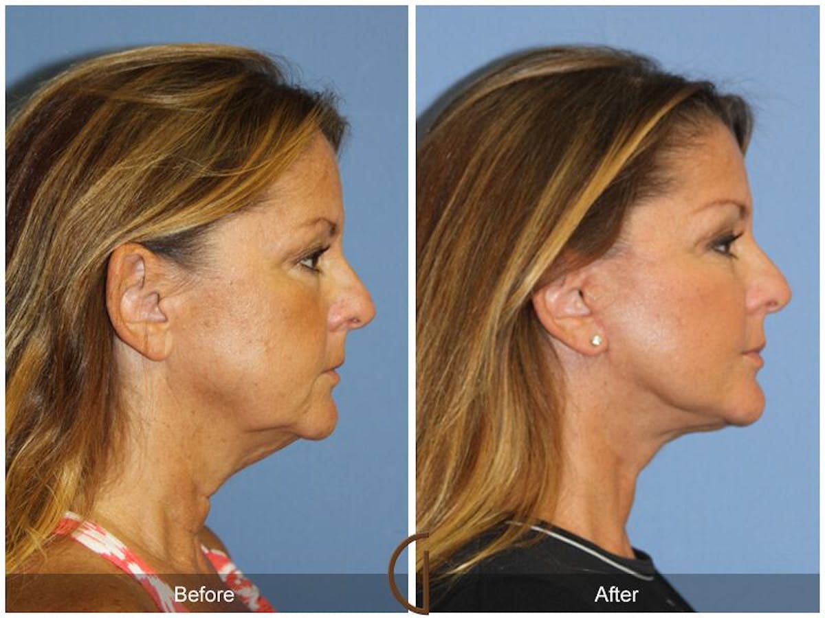 Facelift 50s Before & After Gallery - Patient 249021 - Image 3