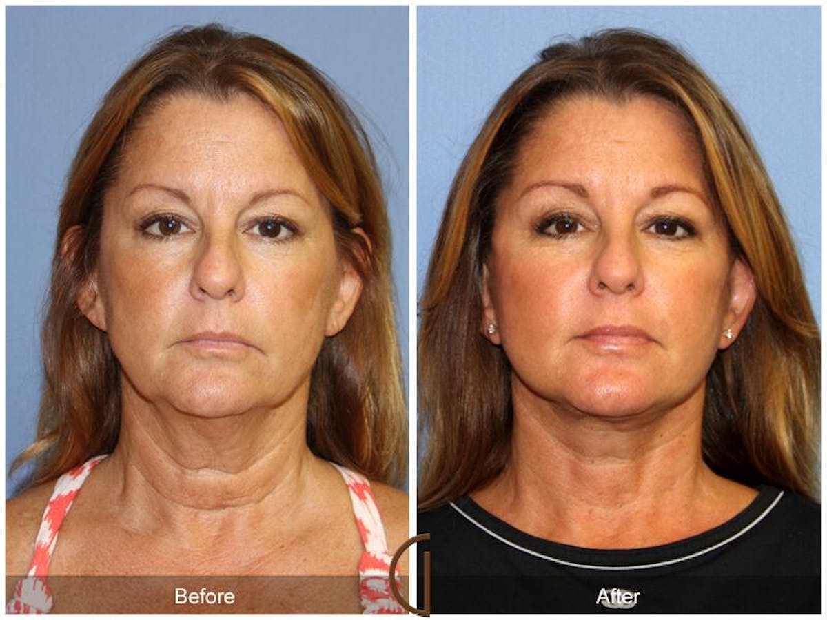 Facelift 50s Before & After Gallery - Patient 249021 - Image 2