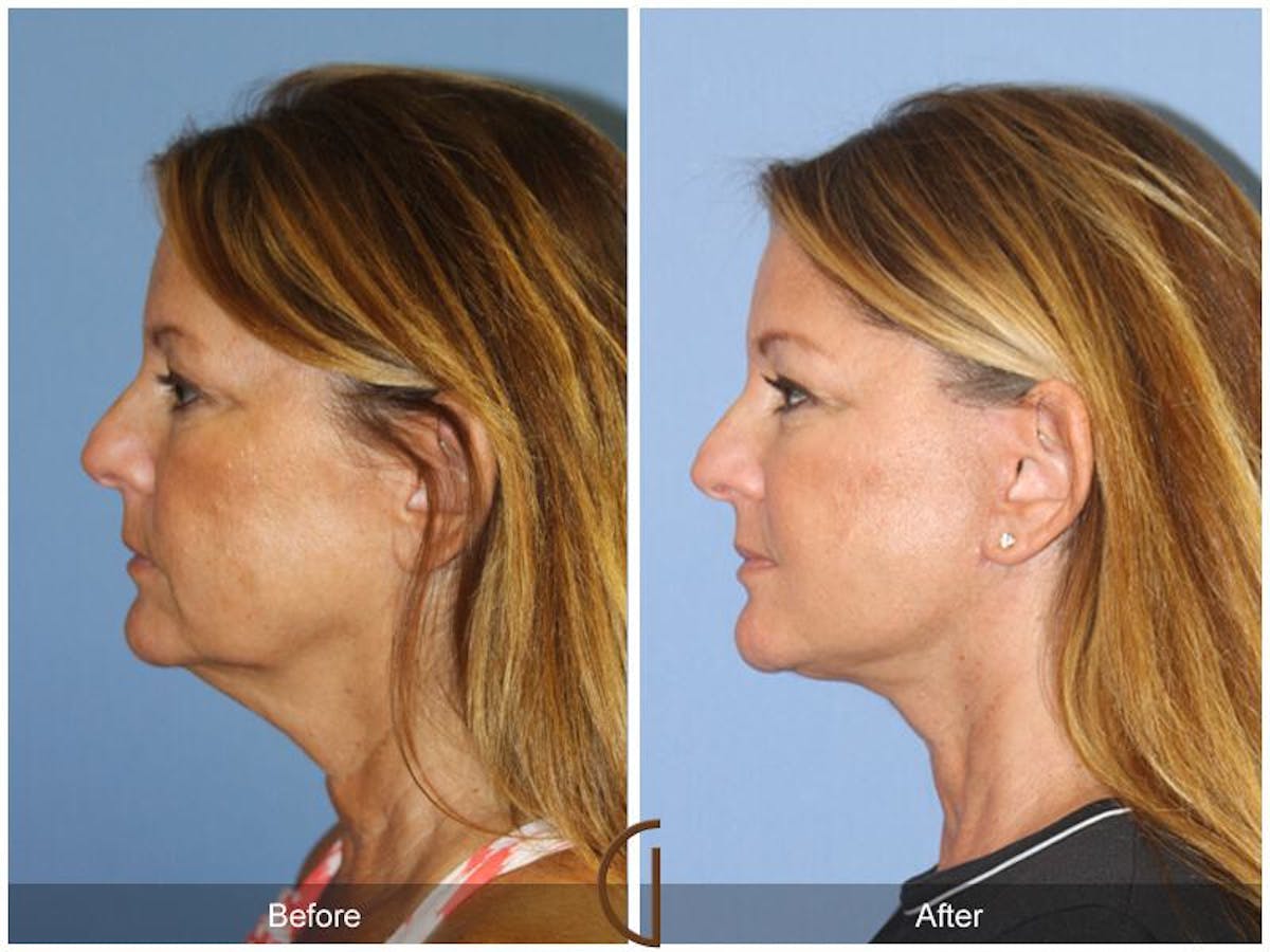 Facelift 50s Before & After Gallery - Patient 249021 - Image 1