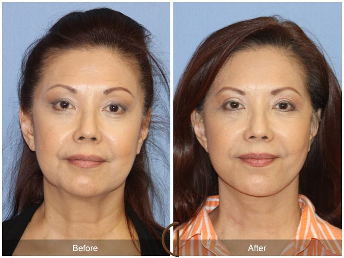 Facelift 50s Before & After Gallery - Patient 100259 - Image 2