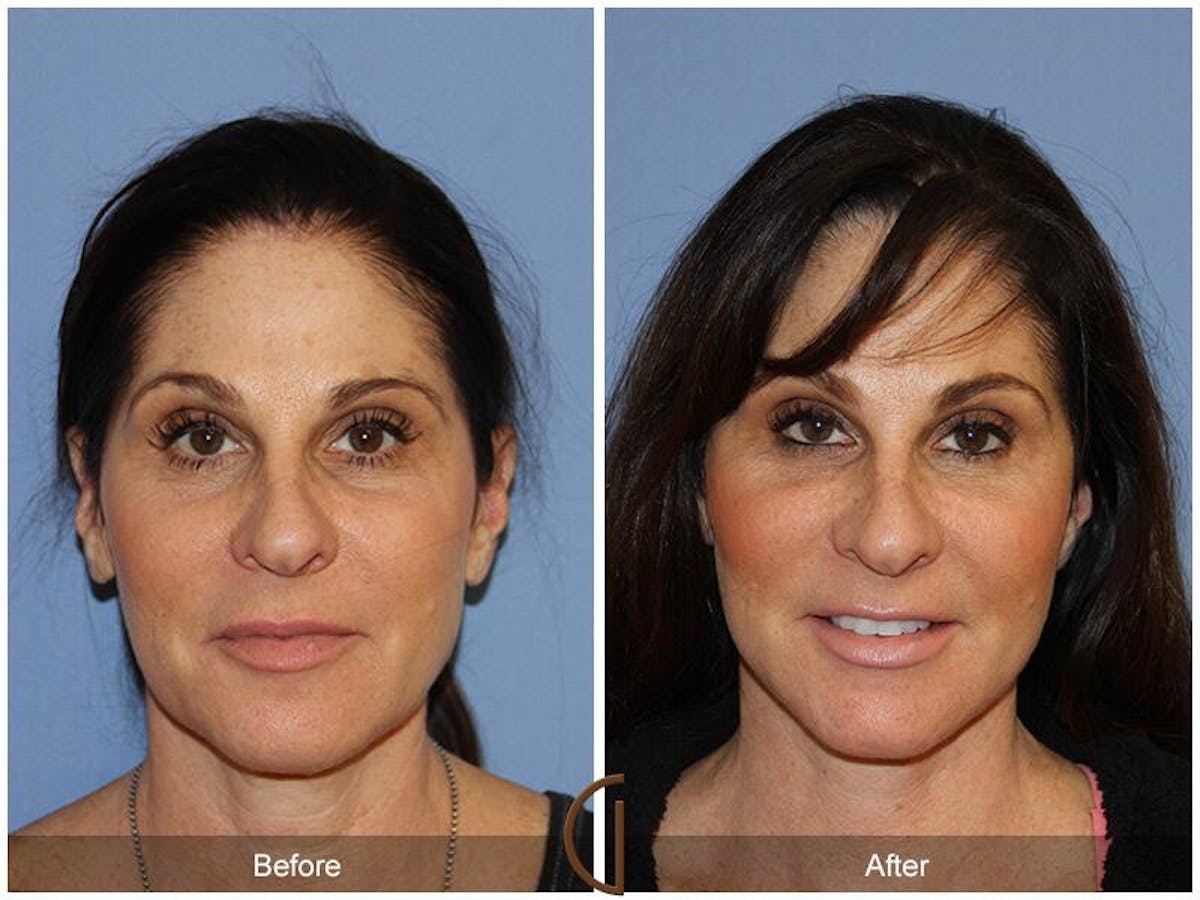 Facelift 50s Before & After Gallery - Patient 379063 - Image 2