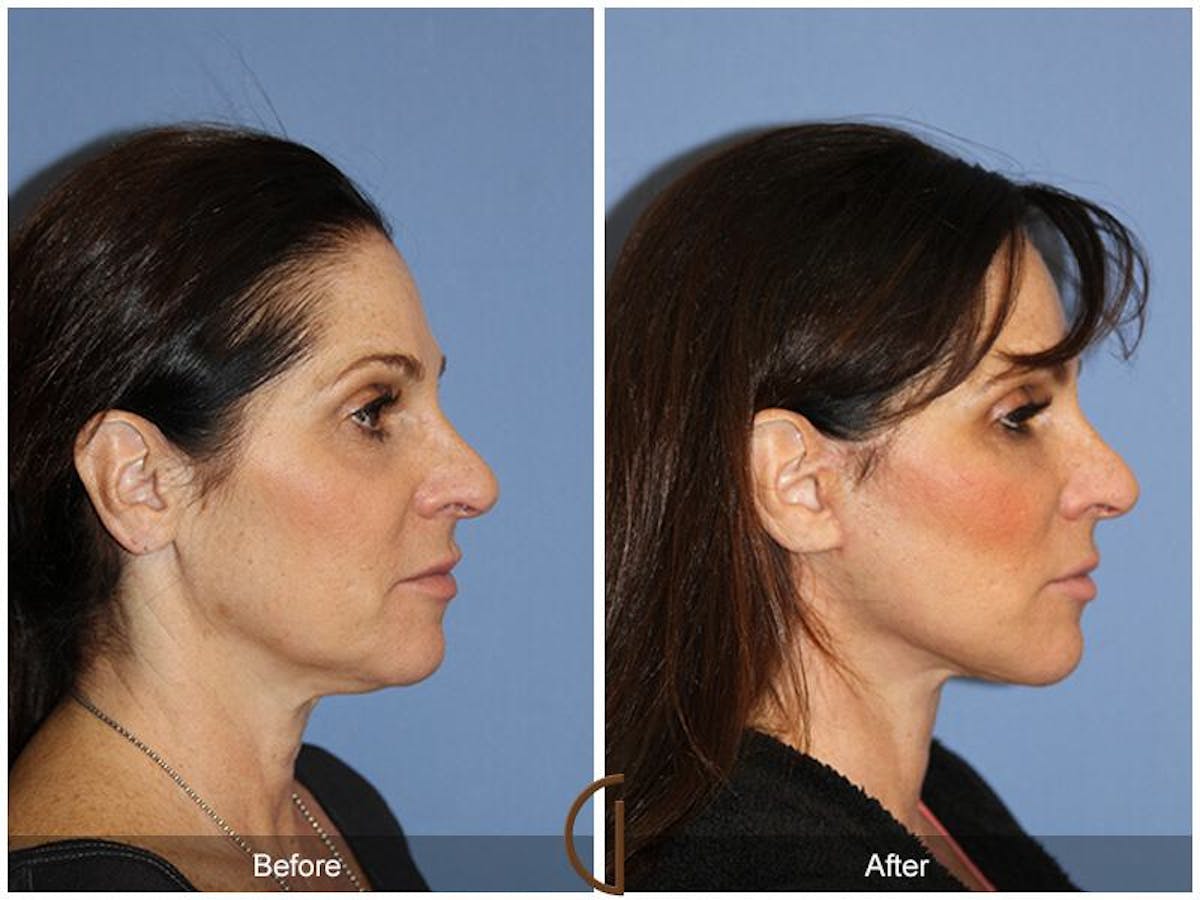Facelift 50s Before & After Gallery - Patient 379063 - Image 3