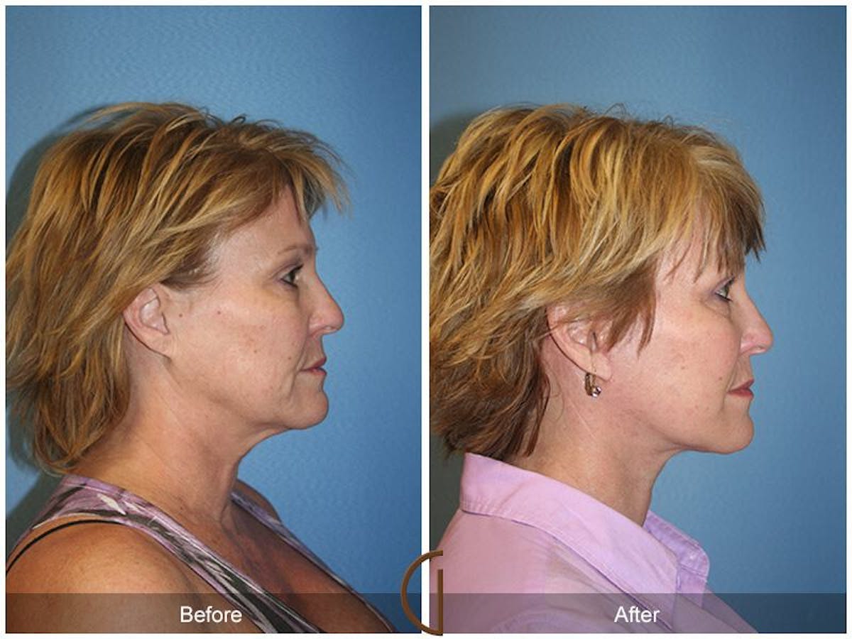 Facelift 50s Before & After Gallery - Patient 260424 - Image 3