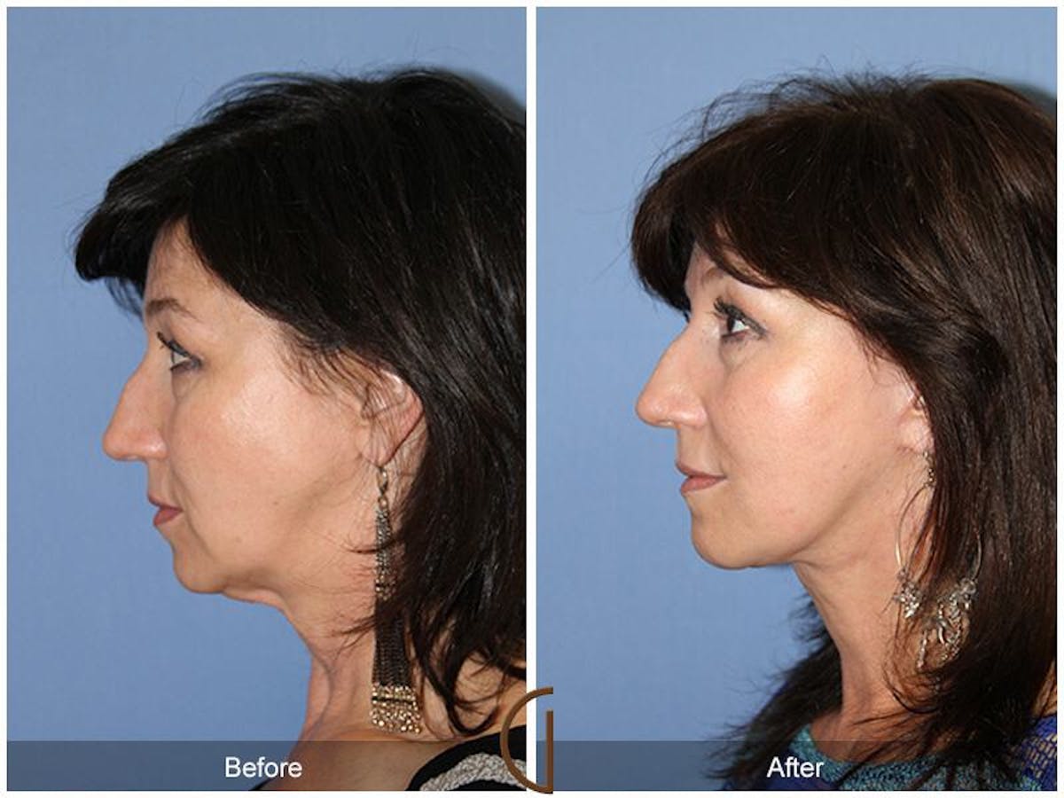 Facelift 50s Before & After Gallery - Patient 228621 - Image 1