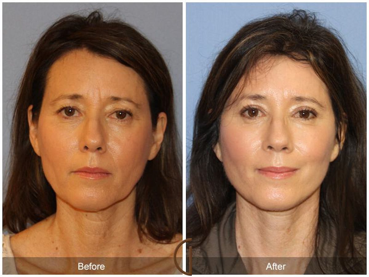 Facelift 50s Before & After Gallery - Patient 559924 - Image 2
