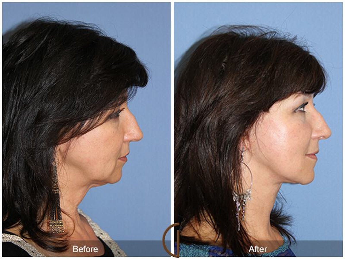 Facelift 50s Before & After Gallery - Patient 228621 - Image 3