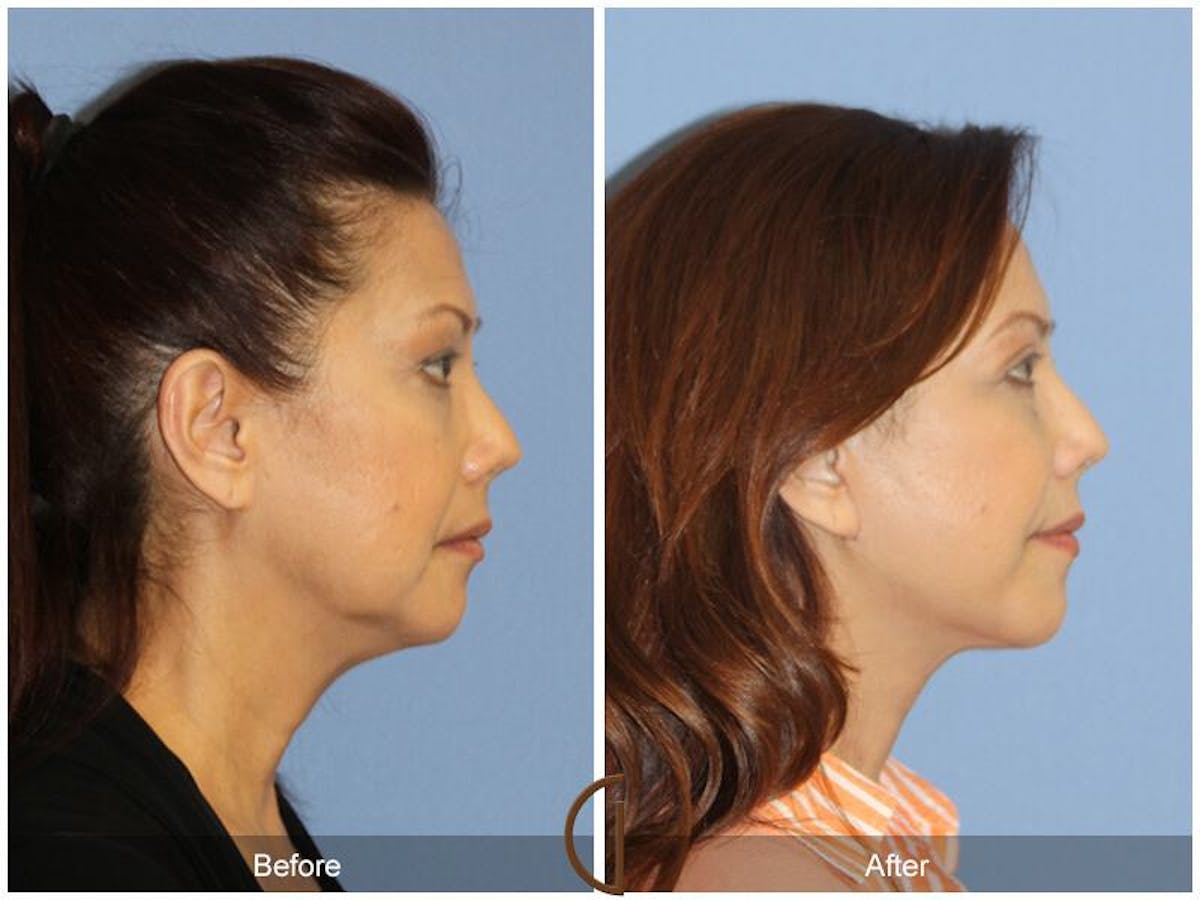 Facelift 50s Before & After Gallery - Patient 100259 - Image 3