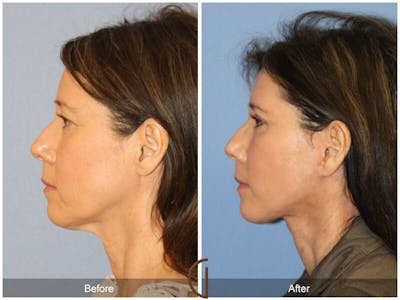Facelift 50s Before & After Gallery - Patient 559924 - Image 1