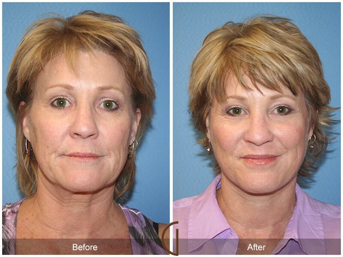 Facelift 50s Before & After Gallery - Patient 260424 - Image 2