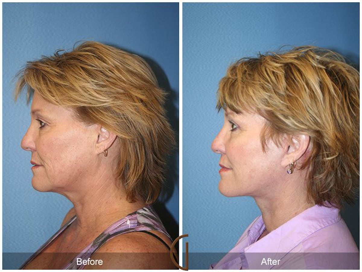 Facelift 50s Before & After Gallery - Patient 260424 - Image 1