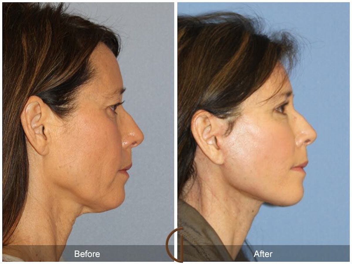 Facelift 50s Before & After Gallery - Patient 559924 - Image 3