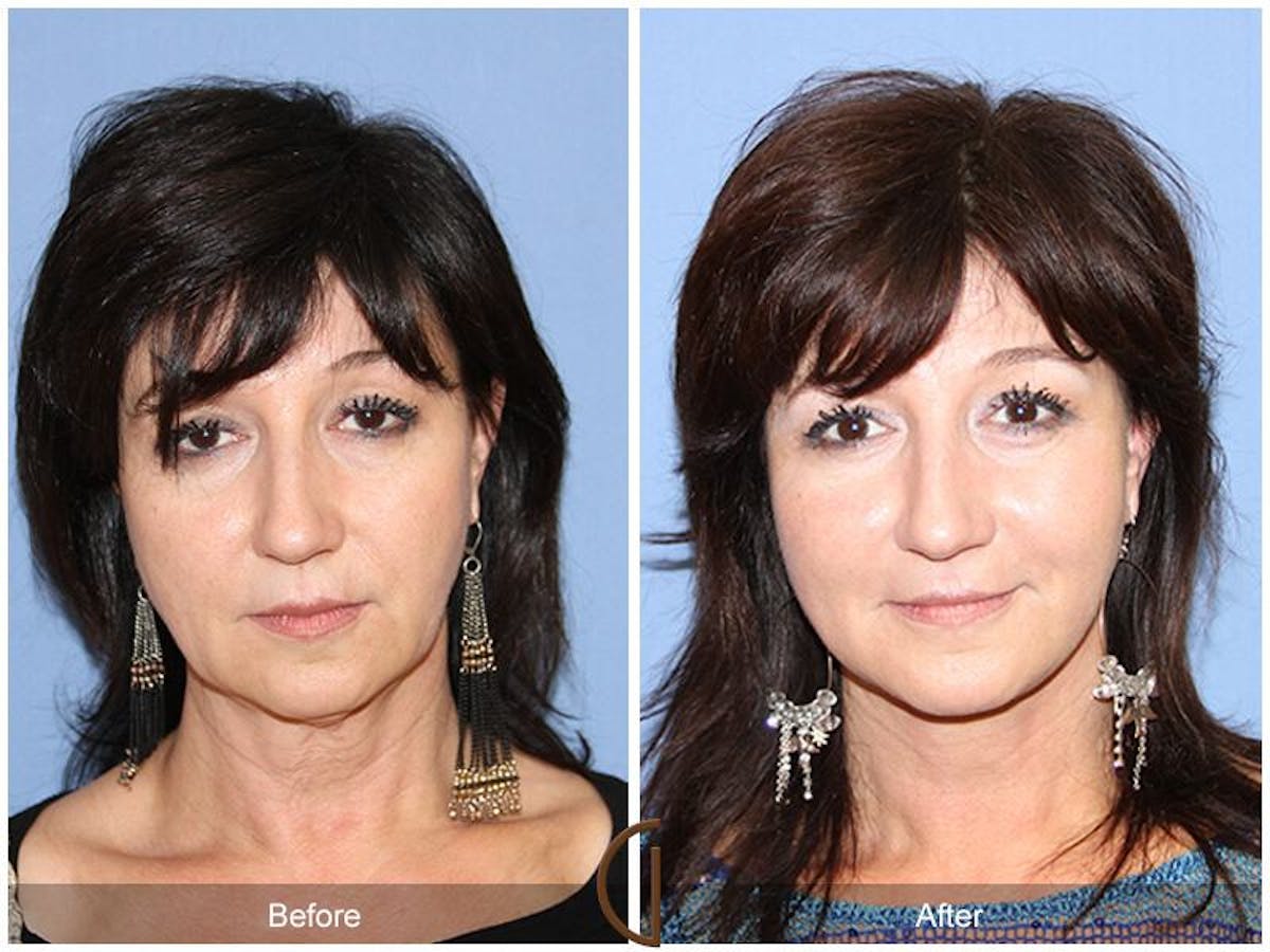 Facelift 50s Before & After Gallery - Patient 228621 - Image 2
