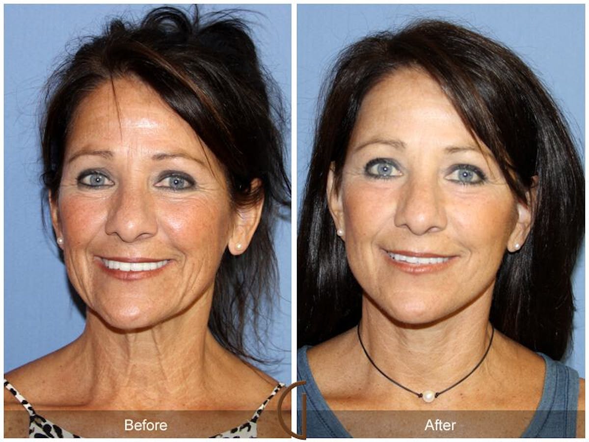 Facelift 50s Before & After Gallery - Patient 106125 - Image 2