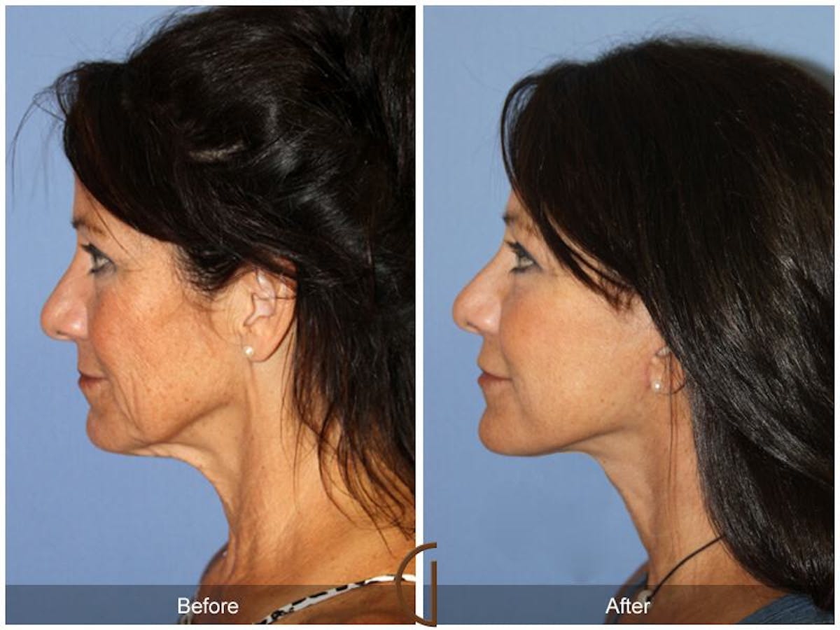 Facelift 50s Before & After Gallery - Patient 106125 - Image 1