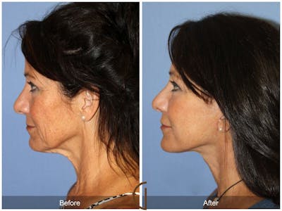 Facelift 50s Before & After Gallery - Patient 106125 - Image 1