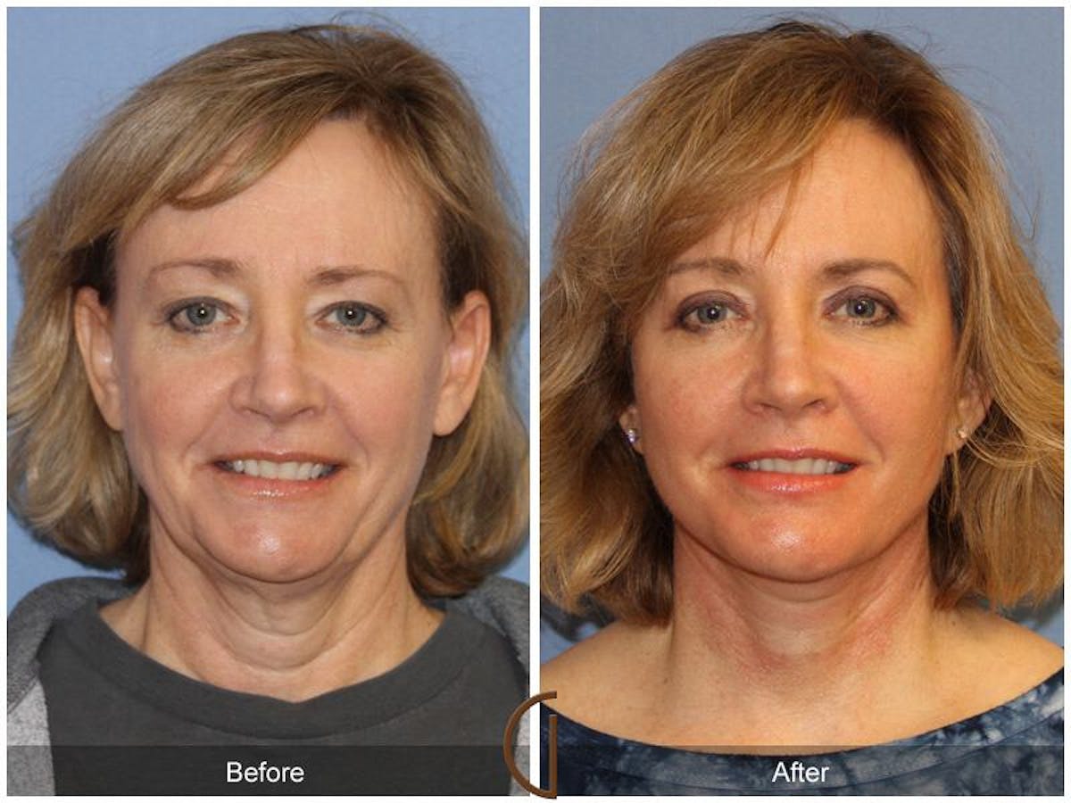 Facelift 50s Before & After Gallery - Patient 293903 - Image 2