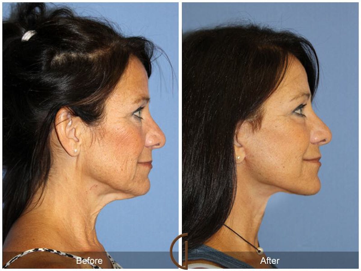Facelift 50s Before & After Gallery - Patient 106125 - Image 3